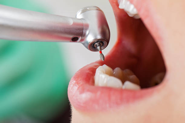 Best Emergency Broken Tooth Repair in Custer, SD